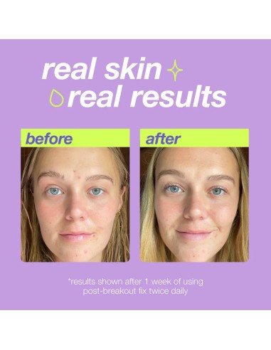 Dermalogica Post-Breakout Fix