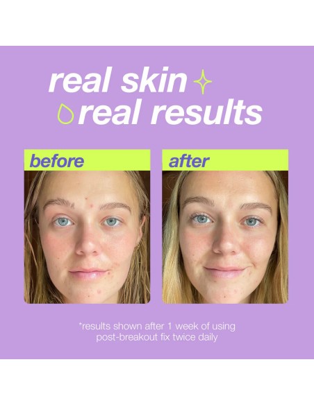 Dermalogica Post-Breakout Fix
